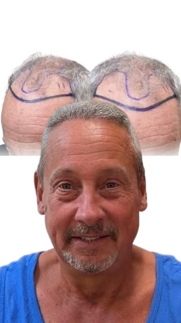 The best hair transplant result doesn’t look like a hair transplant. It looks like you on a really g