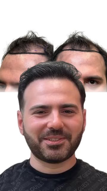 Aron tells it in his own words. 7 months after 4,200 grafts with maxim Hair Restoration, he’s loving