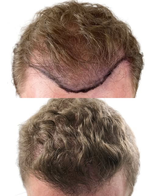 Now you see thinning hair. Now you don’t. The right hair transplant can solve that issue and complet