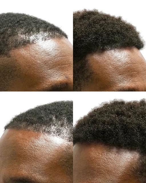 A fuller hairline, stronger density, and more even coverage can completely change the way the hair l