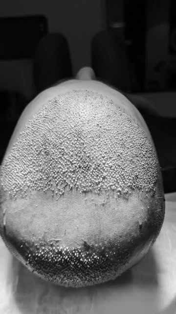 Every graft has a purpose. Extraction is a critical part of a hair transplant, but what happens next