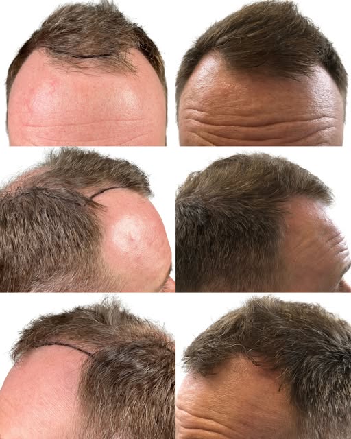 Filling in the hairline and crown can have a major impact on your overall profile. These areas shape