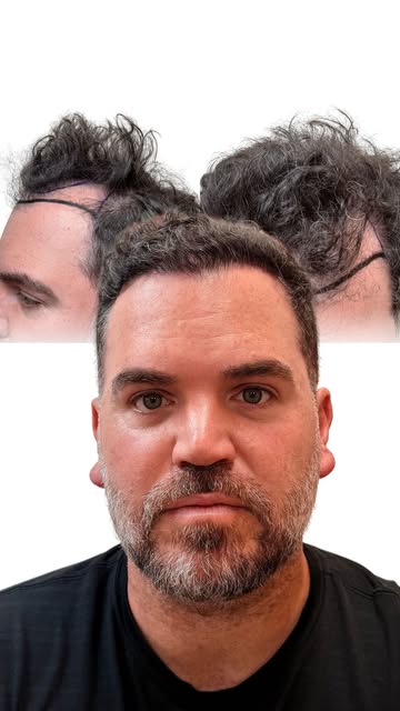 If you’ve been thinking about a hair transplant but still feel a little nervous or skeptical, this o