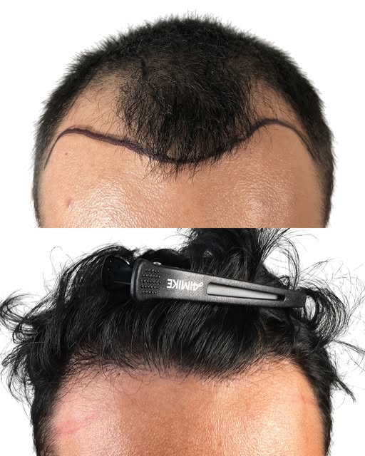 A natural-looking hairline is about more than just filling in areas where hair has been lost. For th