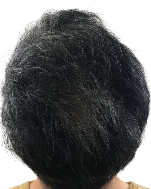 Did you know that crown hair transplants can take longer to show their final results than hairline t