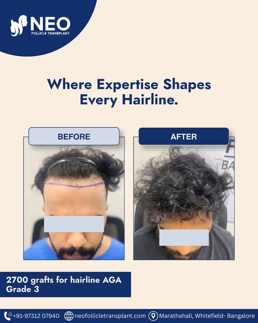 Hair restoration is not just about adding hair. It is about designing a result that looks natural, b