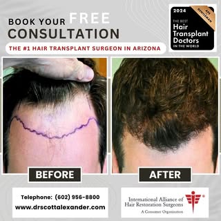 Voted one of the very best hair transplant surgeons in the world and part of the prestigious IAHRS.

