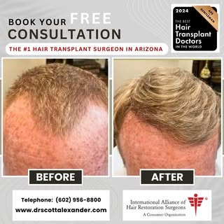 3114FU with Dr Scott Alexander in Arizona. 

Voted one of the very best hair transplant surgeons in 