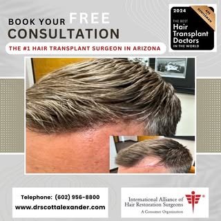 2185 FU with Dr Scott Alexander in Arizona. 

Voted one of the very best hair transplant surgeons in