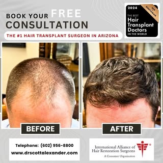 1 year post op 2023 FU via FUE with Dr Scott Alexander.

surgeons in the world and part of the prest