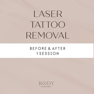 We are very pleased to see great results like these after just 1 session of Laser Tattoo Removal. 

