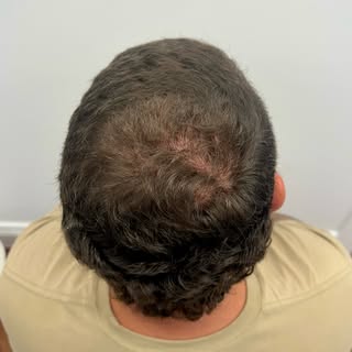 Swipe to see the transformation →

Getting older hits different when your hair starts disappearing a