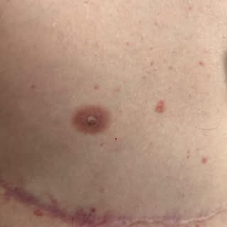 Did you notice?

Those nipples are tattooed on. Those nipples are healed results. 

Another extraord