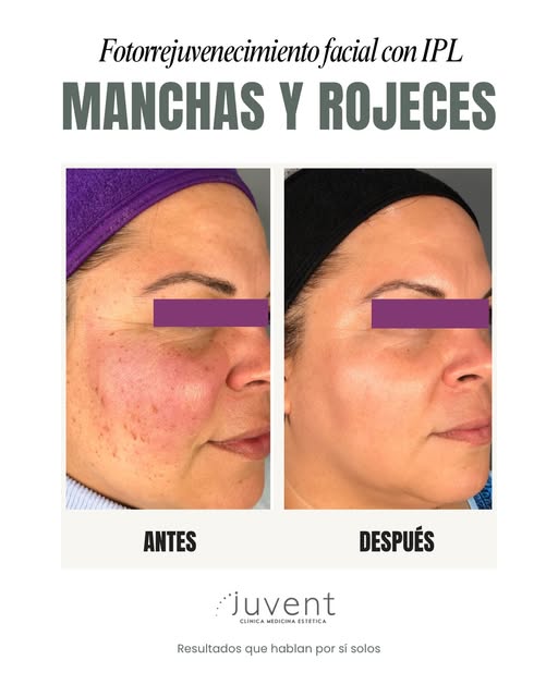 Así ha sido el resultado de este caso real donde hemos trabajado con IPL ⚡️(Luz Pulsada Intensa) las