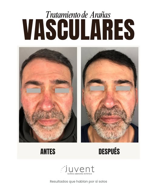 😰¿Te preocupan esas venitas rojas que tienes en la cara?
Tranquil@, son inofensivas pero poco estét