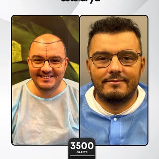 The first step is trust, the result is confidence 

Our patient had their first hair transplant sess
