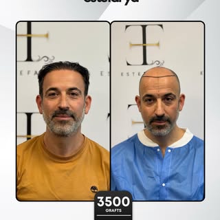 Natural and dense results with a 3500 Graft Sapphire FUE touch. 
Entrust your transformation to expe