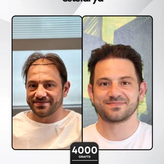 4000 graft Sapphire FUE hair transplant for natural and long lasting results.
With proper planning, 