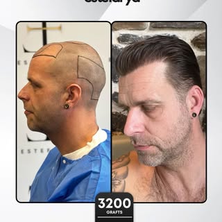 Estefarya | Sapphire FUE Result
Before and after transformation of a hair transplant procedure perfo