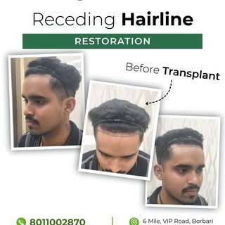 It started with a receding hairline and a lot of self-doubt.
Then came a decision.
And today, 8 mont