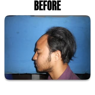 Hair loss took away his confidence at a very young age.
Self-doubt became a daily struggle.

This is