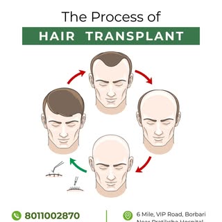 Ever wondered how a hair transplant actually works? 🤔 Swipe left to walk through the complete journ