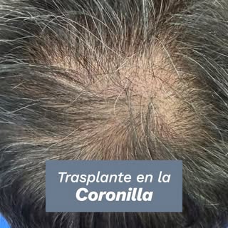 💇‍♂️ ¿Trasplante en la coronilla? ¡Sí funciona!🔑 El secreto está en el ángulo y la dirección de la