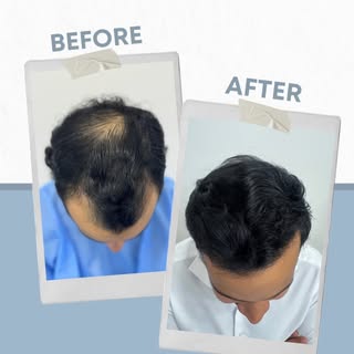 El arte de un trasplante de pelo está en el diseño natural de la línea de implantación y en la densi