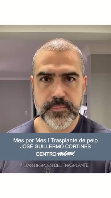 Seguimiento mes por mes de su trasplante de pelo!! Excelentes resultados👏🤗👏 #trasplantedepelo #ha