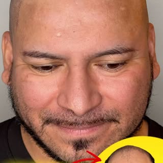 This is just ONE session.

Want your hairline back?

Comment “𝗖𝗢𝗡𝗦𝗨𝗟𝗧𝗔𝗧𝗜𝗢𝗡” to learn mor