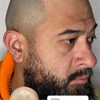One of the reasons I recommend starting conservatively is because you can always lower a hairline la