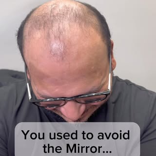 🪞You don’t have to avoid mirrors anymore. 

Want your hairline back?

Comment “𝗖𝗢𝗡𝗦𝗨𝗟𝗧𝗔𝗧𝗜