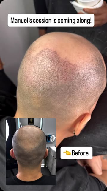 Want your hairline back?

Comment “𝗖𝗢𝗡𝗦𝗨𝗟𝗧𝗔𝗧𝗜𝗢𝗡” to learn more.

📞 (929) 209-2291

📍 1