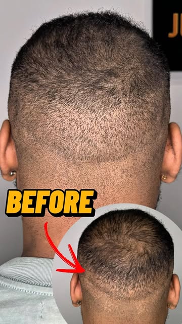 Want to camouflage your transplant scars?

Comment “CONSULTATION” to learn more.

📞 (929) 209-2291
