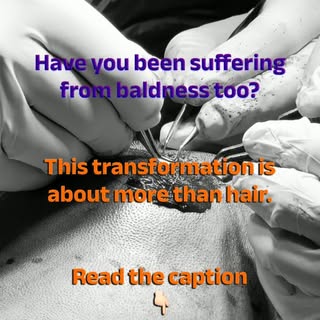 This is more than a hair transformation—it’s a confidence transformation.

When our patient first ca
