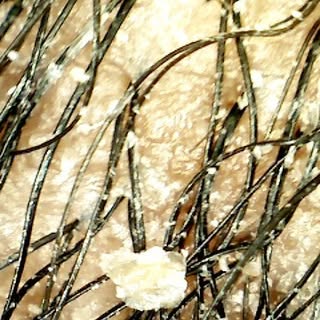 SWIPE for after 🤳🏽

Do you suffer with itchy flaky scalp? 

Seborrheic Dermatitis is a long term s