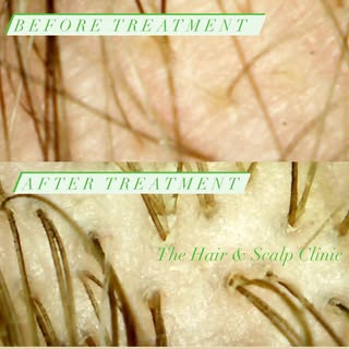 #hairloss #alopecia #hair #hairlosssolution #hairtransplant #hairlosstreatment #hairgrowth #haircare