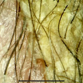 👤PITYRIASIS AMIANTACEA👤

Swipe to see before and after images from the Derma Vision 

#scalptreatm