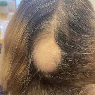 ALOPECIA - is a devastating condition for those suffering. We understand #willsmith and #jadapinkett