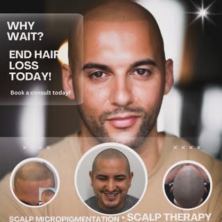 Scalp Micropigmentation is the hair loss solution you’ve been looking for but you may have never kno
