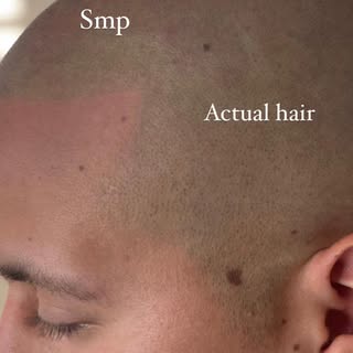 A life changing hair loss treatment is only one click away 😎 TEXT us (719-377-5700) scalp pictures 