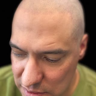 Just another day in the life of hair loss restoration 💪🏾 
Reach out to us to change your life by c