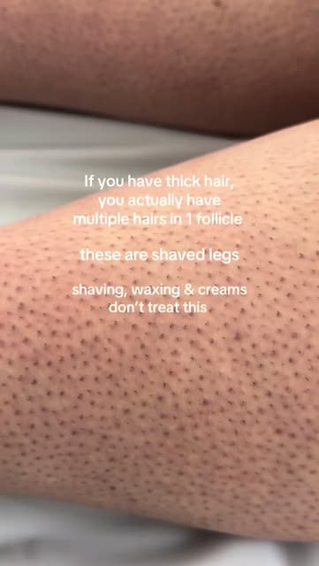 Thick, coarse hair? Waxing and hair-removal creams only remove hair temporarily—they don’t reduce th