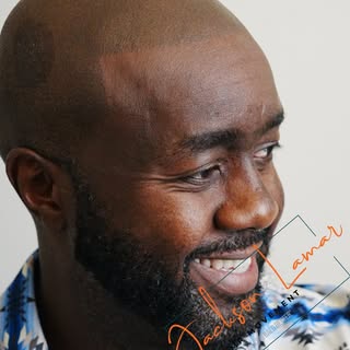 Say goodbye to bad hair days with scalp micro pigmentation hey Dallas, Texas check out this gentlema