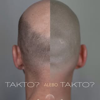 „Takto alebo takto?“ 😊

Vlasy nerobia človeka. Sebavedomie tiež nemusí závisieť od hustoty vlasov.
