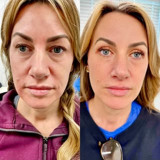 This is a six week follow up from a mini lift upper lid Bluff, plasty and CO2 laser resurfacing.#min