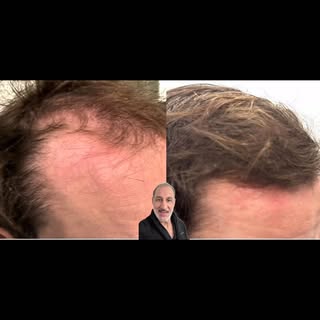 Hairloss treatment #hairloss