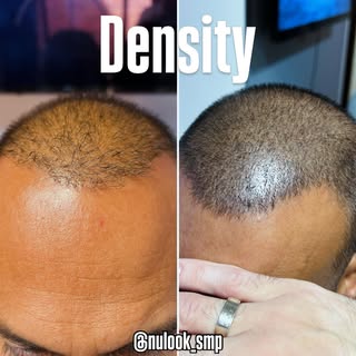 This is what a Male Density Treatment (SMP) can do in just a few sessions.

No more worrying about t