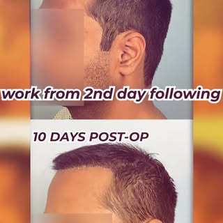 •	“Long hair transplant — no shave”
•	“Immediate, natural results”
•	“Day 1: back to work”
•	“Minima