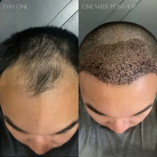 🌟 One Week Post FUE Hair Transplant Update! 🌟

The recovery after a Follicular Unit Extraction (FU